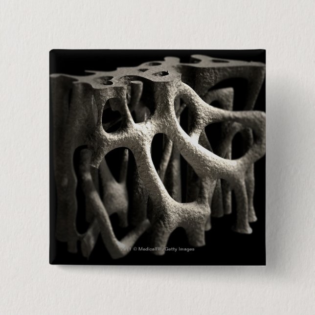 Structure of a bone with osteoporosis 2 inch square button (Front)