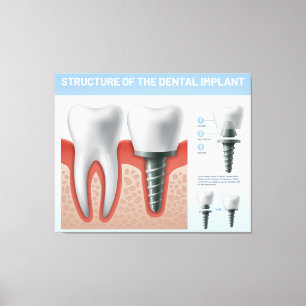 Structure of the Dental implant Canvas Print