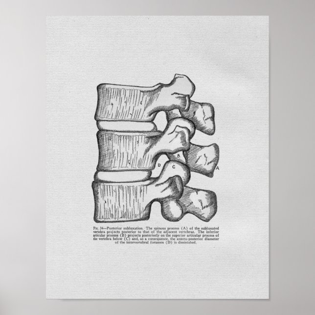 Subluxe Vertébrale Chiropratique Impression Vintag (Devant)