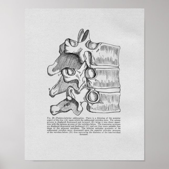 Subluxe Vertébrale Chiropratique Impression Vintag (Devant)