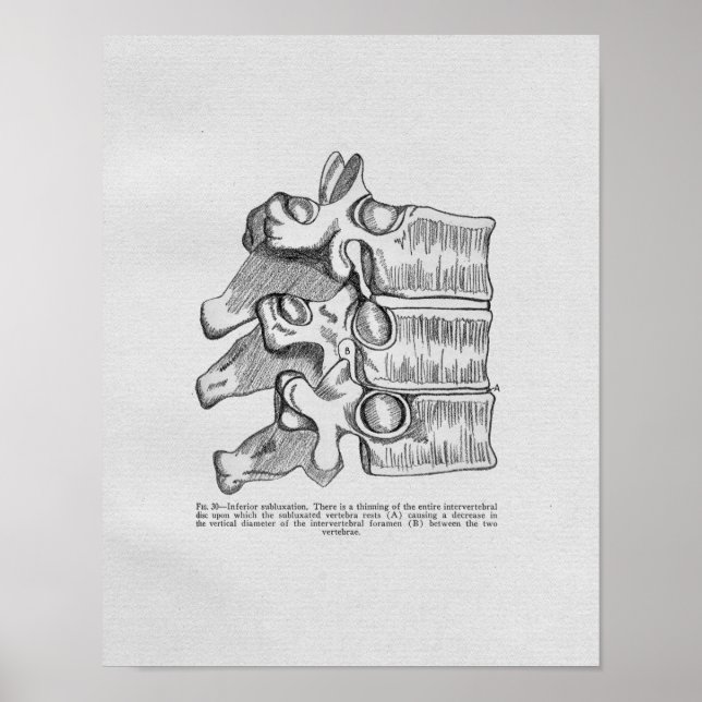 Subluxe Vertébrale Chiropratique Impression Vintag (Devant)