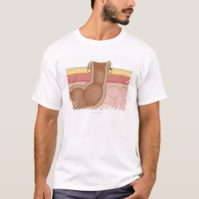 T-shirt Colostomie permanente (Devant)