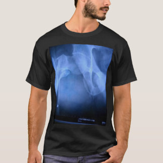 T-shirt fémur cassé