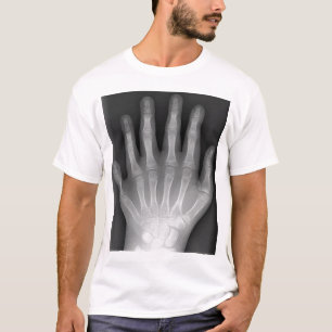 T-shirt Polydactyly, six mains digitées, rayon X, rareté !