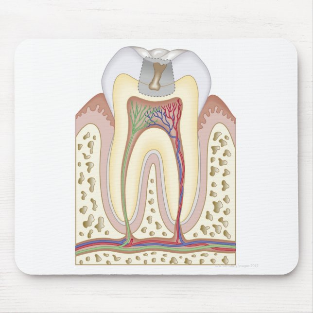 Tapis De Souris Illustration de la carie dentaire (Devant)
