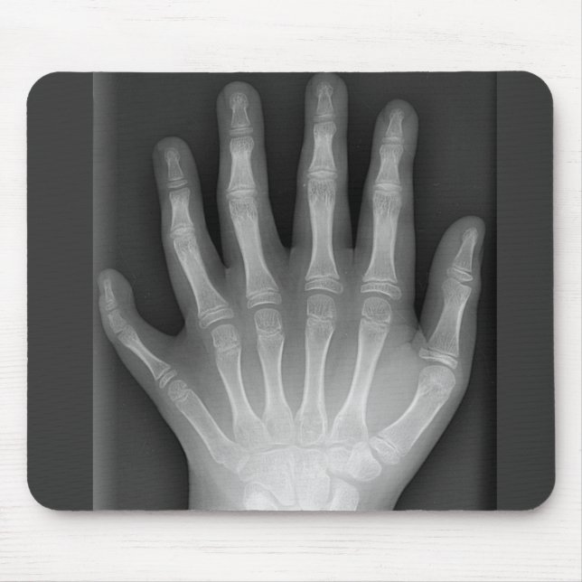 Tapis De Souris Six mains digitées, rareté Médicale, rayon X (Devant)