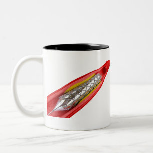 Tasse 2 Couleurs Procédure d'angioplastie