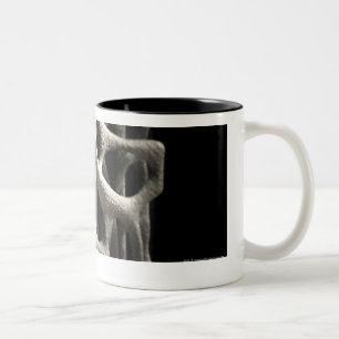 Tasse 2 Couleurs Structure d'un os avec l'ostéoporose