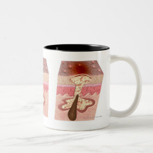 Tasse 2 Couleurs Vue de ce qui cause l'acné
