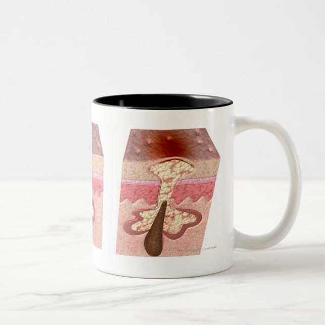 Tasse 2 Couleurs Vue de ce qui cause l'acné (Droit)