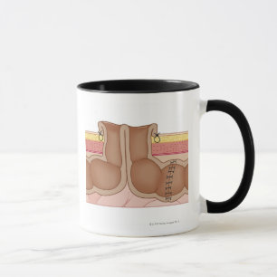 Tasse Colostomie provisoire