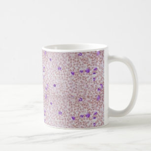 Tasse de café - leucémie myéloïde chronique (CML)