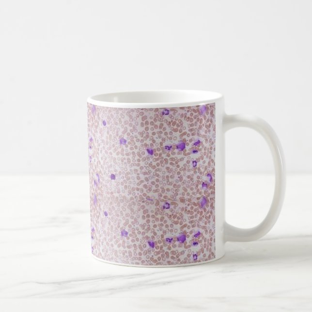 Tasse de café - leucémie myéloïde chronique (CML) (Droite)