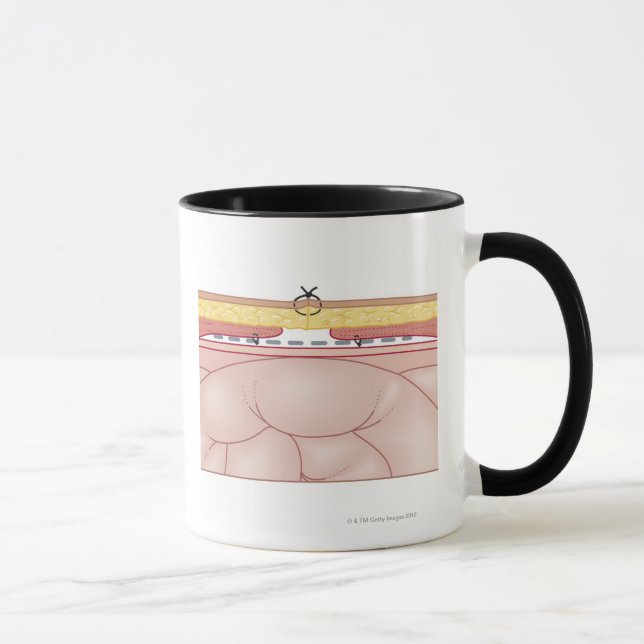 Tasse Illustration d'une hernie (Droite)