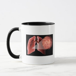 Tasse Voie aérienne d'Inflammed pendant une crise