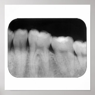 Teeth with filling poster