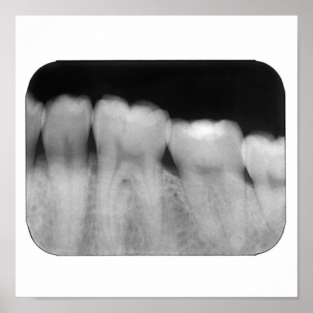 Teeth with filling poster (Front)