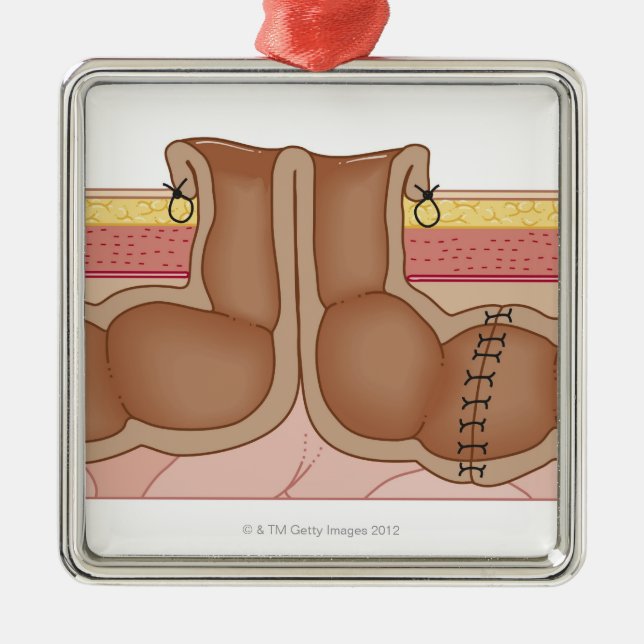 Temporary Colostomy Metal Ornament (Front)