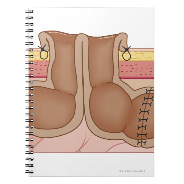 Temporary Colostomy Notebook (Front)
