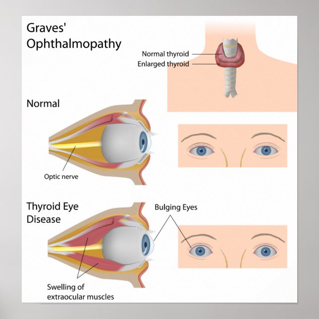 Thyroid eye disease Poster (Front)
