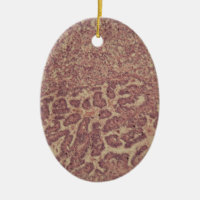 Thyroid gland cells with cancer