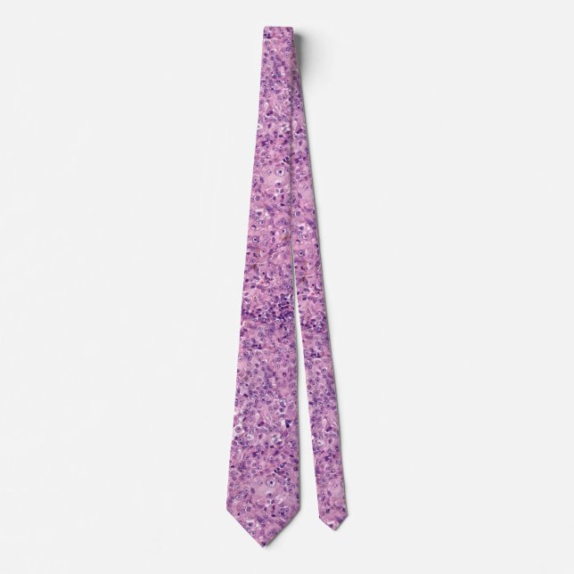 Tie showing uveal melanoma (Front)