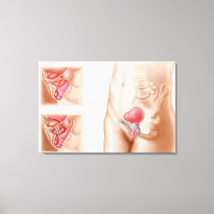 Toile Anatomie De La Procédure De Suspension De Vessie