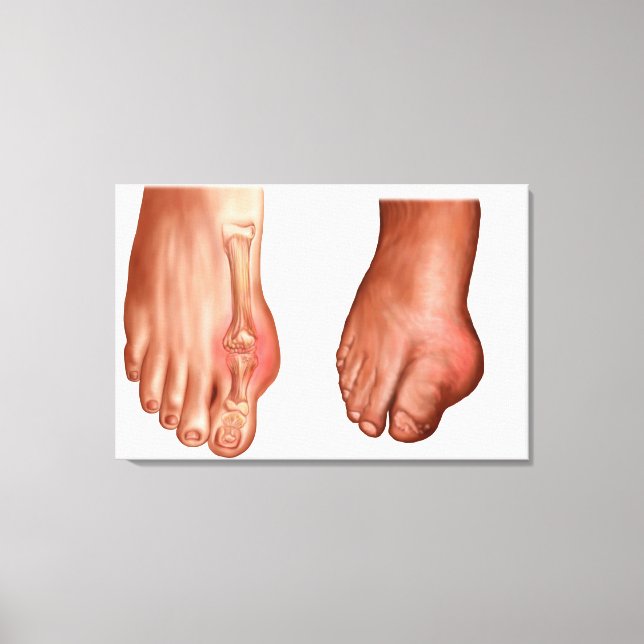 Toile Anatomie D'Un Pied Gonflé (Recto)