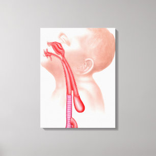 Toile Anatomie D'Une Fistule Trachéesophagienne