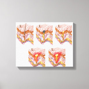 Toile Différents Types D'Acné