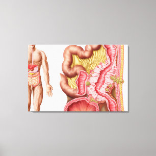 Toile Illustration de diverticulose dans les deux points