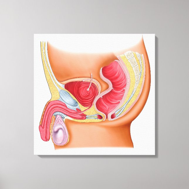 Toile Illustration Médicale D'Une Fistule Rectouréthrale (Recto)