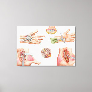 Toile Illustration Médicale montrant le tunnel carpal