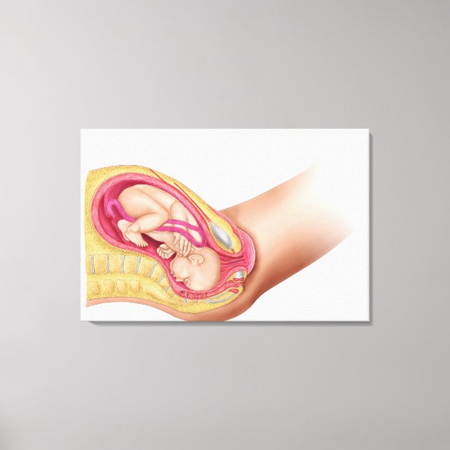 Toile Illustration Montrant La Livraison Du Foetus 2 (Recto)