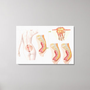 Toile Ilustration Médicale d'un kyste Pilonidal