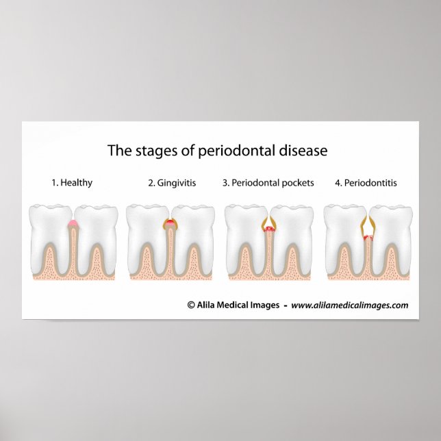Tooth Periodontal Disease Poster (Front)