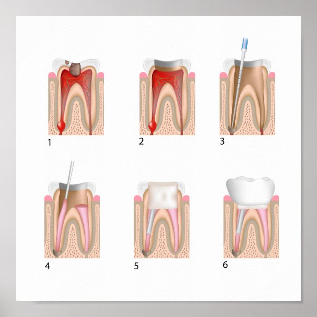 Traitement du canal racine Toute taille Poster (Devant)