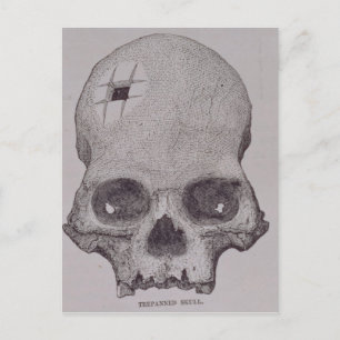Trepanned Skull Postcard