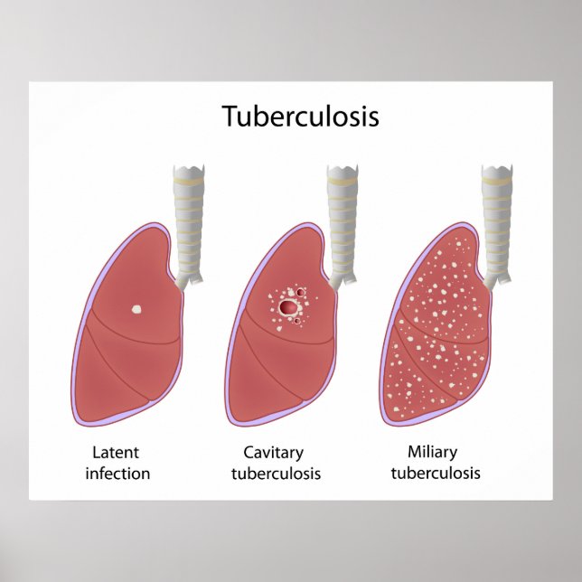 Tuberculosis types Poster (Front)