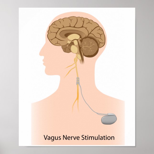 Vagus thérapie de stimulation nerveuse Poster (Devant)