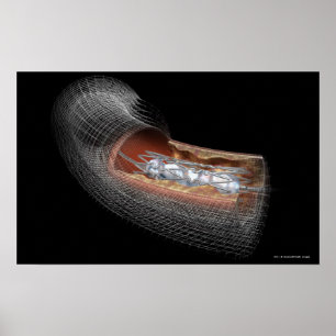 View of an angioplaty balloon in an artery poster
