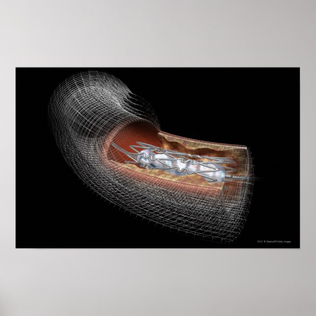 View of an angioplaty balloon in an artery poster (Front)