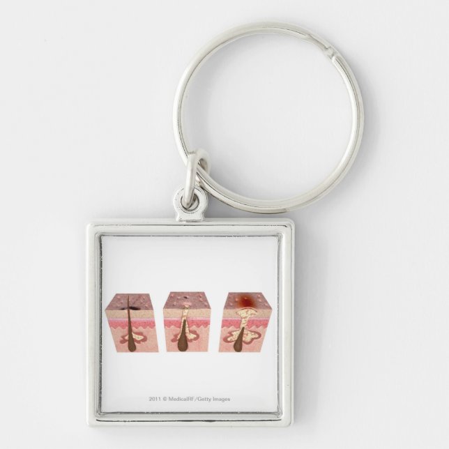 View of what causes acne keychain (Front)