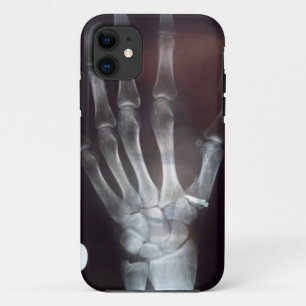 X Ray Hand Phone Case