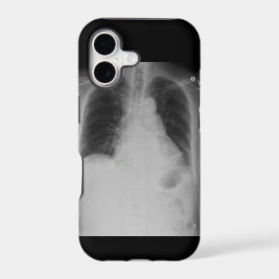 X Ray ~ iPhone 5 CaseMate case