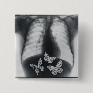 X-ray of butterflies in the stomach 2 inch square button