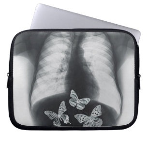 X-ray of butterflies in the stomach laptop sleeve