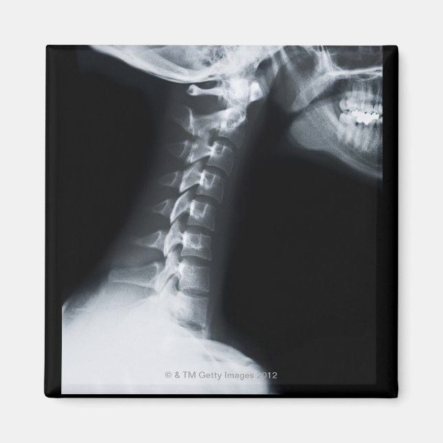X ray of neck vertebrae including lower jaw magnet (Front)